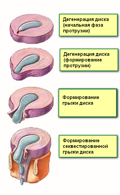 формирование грыжи диска